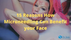 15-Reasons-Microneedling-Is-Needed-As-a-Helps-Skin-Acne-Treatment