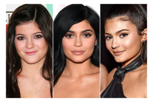 Kylie-Jenner-botox