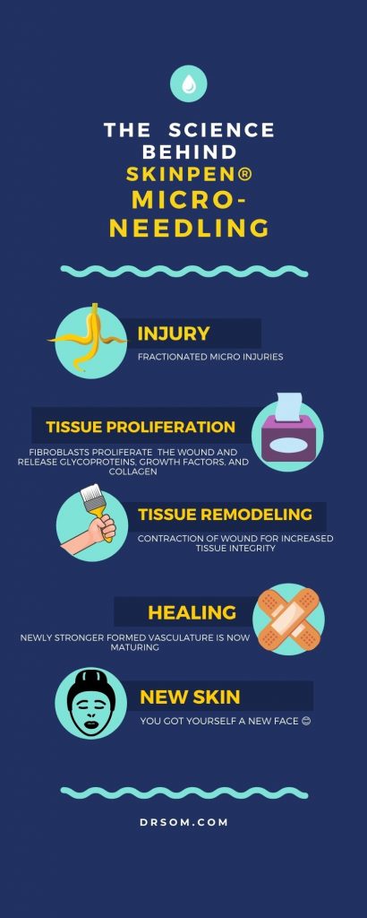 microneedling-infographic micro-needling-infographic