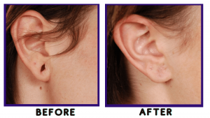 earlobe-repair-surgery-before-and-after