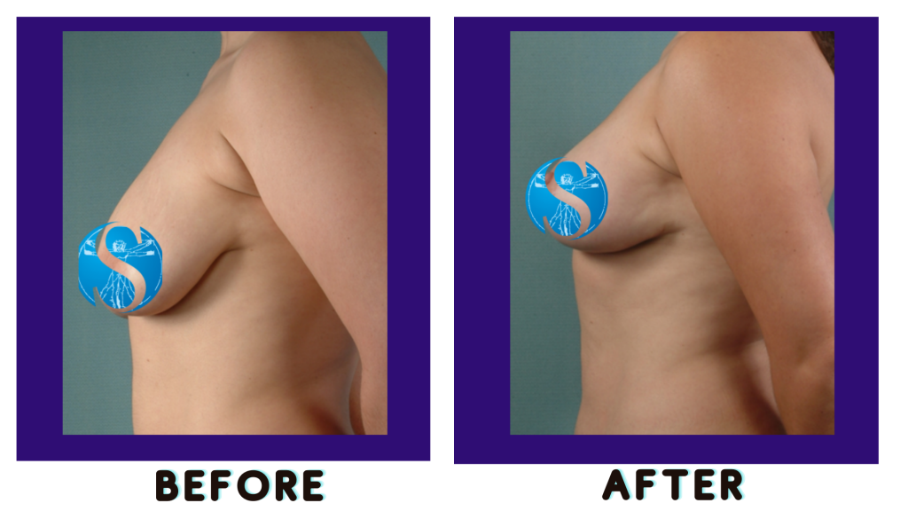 Breast Lift Mastopexy, Full Lift Beverly Hills