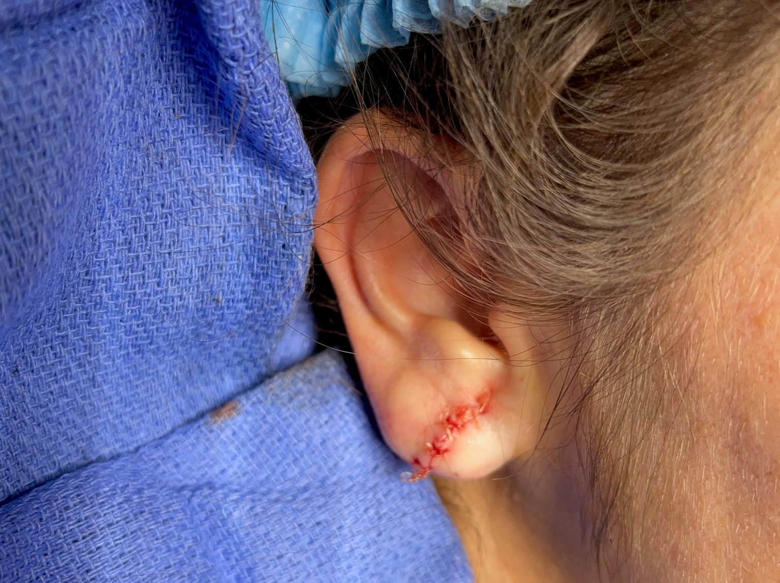 What It's Like Getting Earlobe Repair Surgery