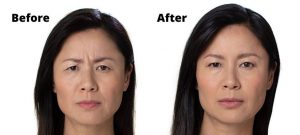 Botox 11 Lines Before and After