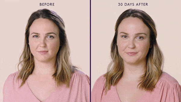 botox-women-before-after-gif