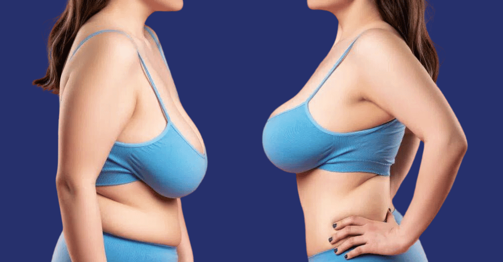 Breast-Augmentation-Breast-Lift-Compare